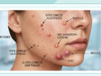 Cara mengatasi jerawat pada remaja dengan langkah sederhana, mulai dari menjaga kebersihan wajah, memilih skincare, hingga menghindari kebiasaan memencet jerawat.